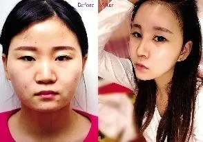 心形脸是什么明星有哪些？24岁女孩爱美为此做全脸手术